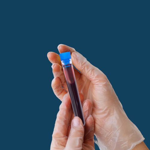 Thrombophilia (fokozott trombózishajlam) laborcsomag